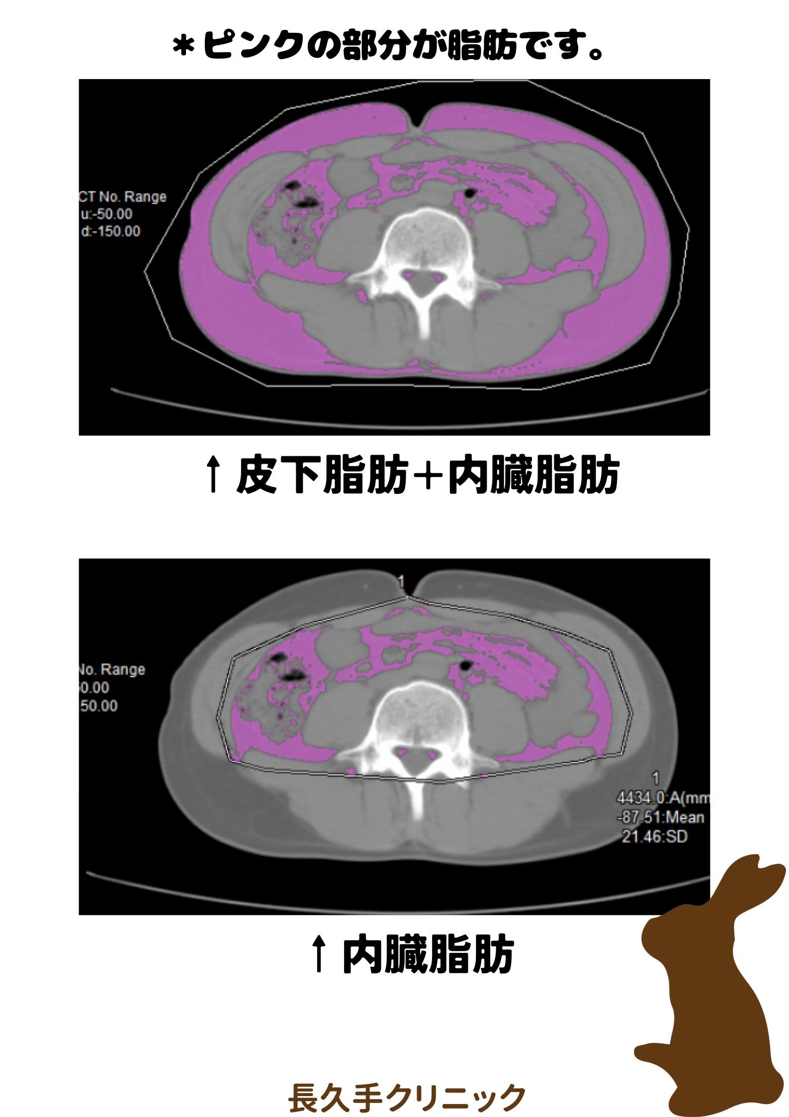 内臓脂肪CT