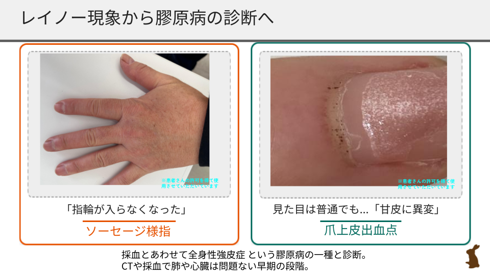 ソーセージ様指：指全体がパンパンに腫れている様子　爪上皮出血点：爪の甘皮部分に見られる黒い点状の出血