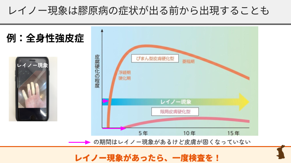 全身性強皮症：レイノー現象と皮膚硬化の順序