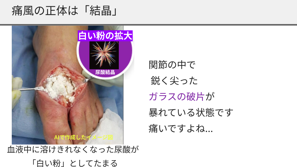 痛風の正体は結晶：関節の中で鋭く尖ったガラスの破片が暴れている状態