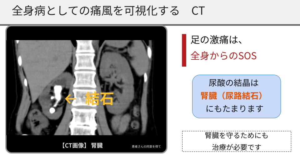 CT画像：腎臓に結石がある様子。足の激痛は全身からのSOS