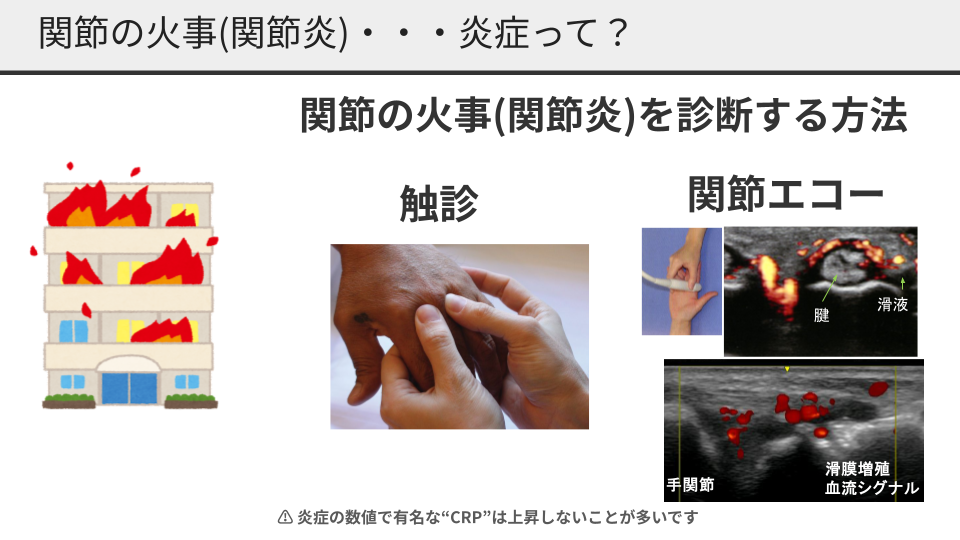 関節の火事関節炎膠原病ブログ用.pptx
