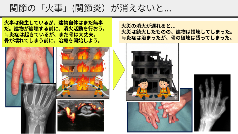 火事が続くとどうなるか：骨の破壊が進んでしまう様子