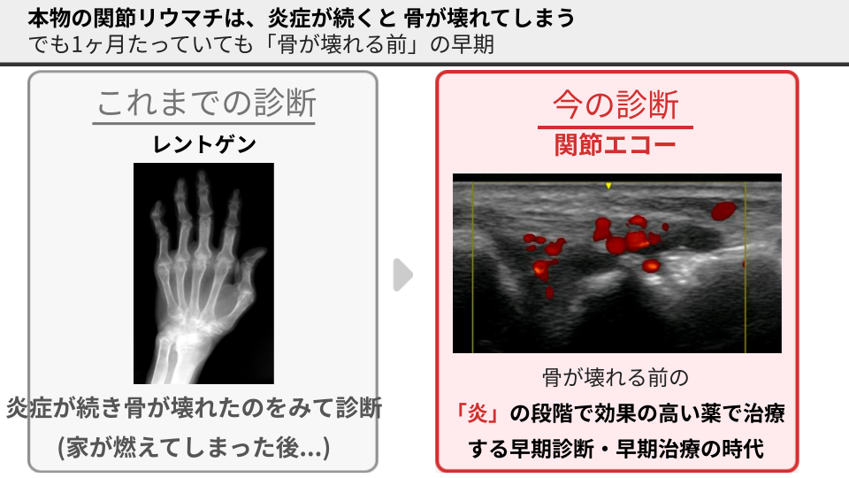 早期とは？焦りすぎないで：発症から骨破壊までのタイムラグ解説