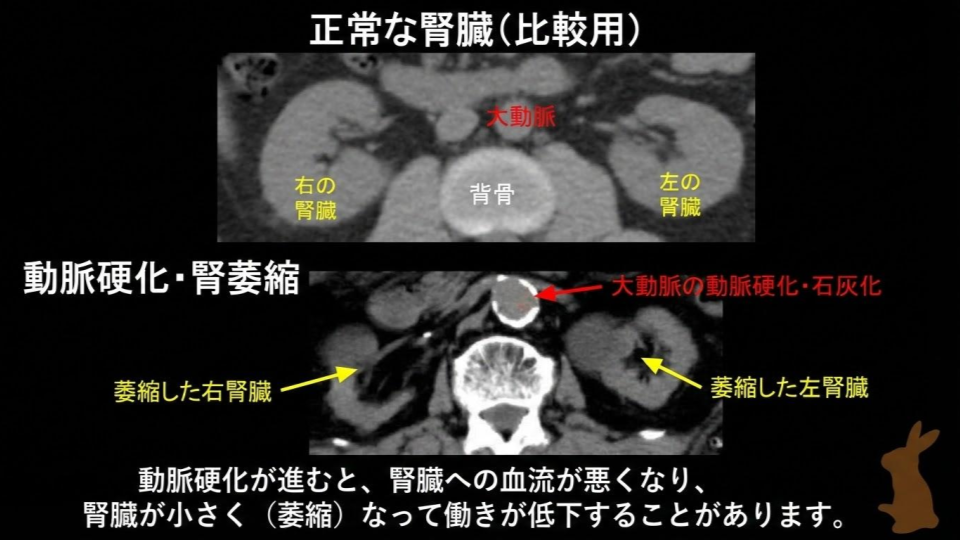動脈硬化と腎萎縮のCT画像