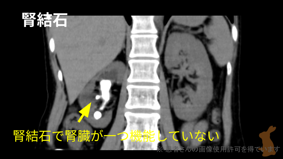 腎結石を伴う片腎のCT画像