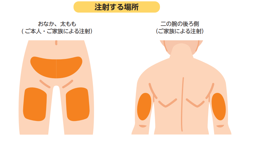 メトジェクトを自己注射できるお腹、太もも、二の腕後ろ側の位置