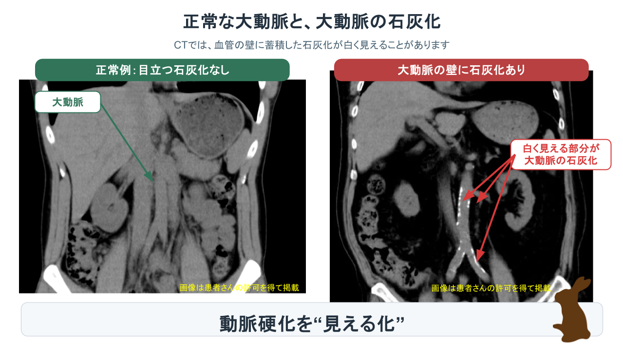正常な大動脈と80歳患者の大動脈石灰化を比較したCT画像