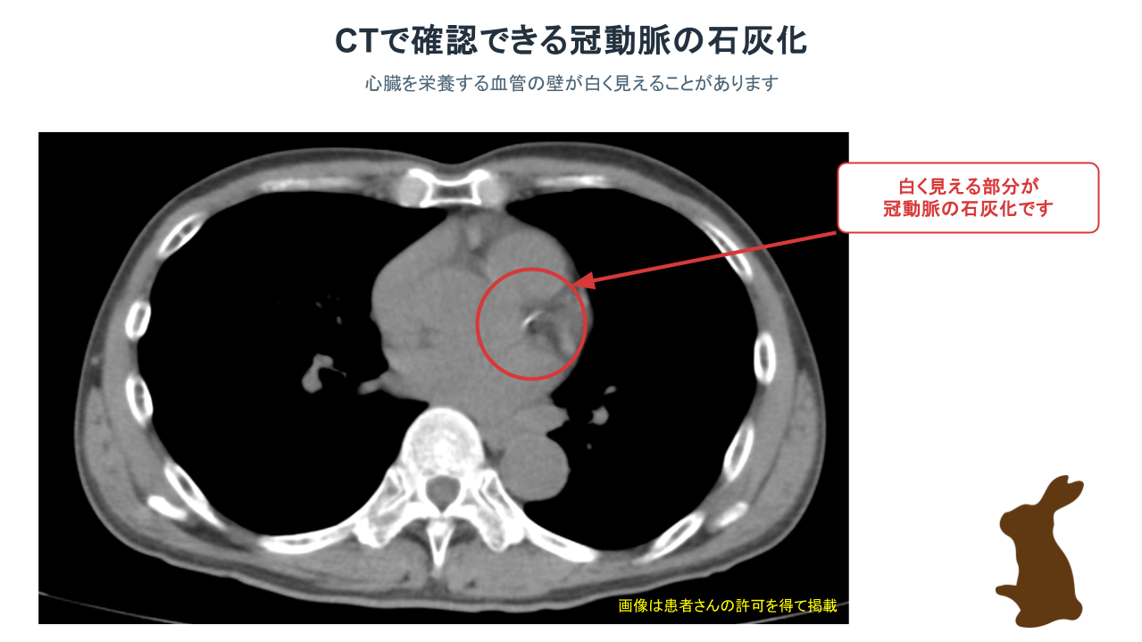 CTで確認された冠動脈石灰化